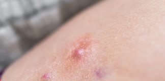 Hidradenitis supurativa, ¿qué tanto sabes de esta enfermedad?.