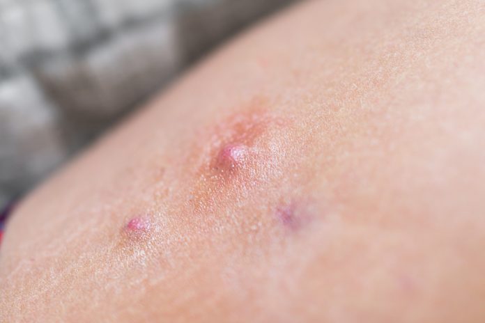 Hidradenitis supurativa, ¿qué tanto sabes de esta enfermedad?.