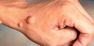 La neurofibromatosis Tipo 1 (NF1), una enfermedad genética “rara”, crónica, grave, discapacitante y progresiva.