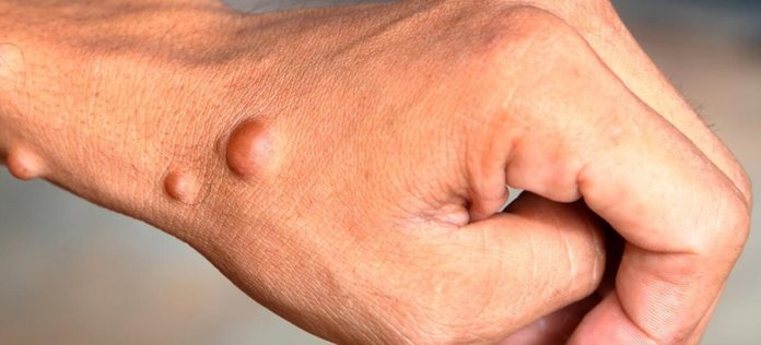 La neurofibromatosis Tipo 1 (NF1), una enfermedad genética “rara”, crónica, grave, discapacitante y progresiva. La neurofibromatosis Tipo 1 (NF1), una enfermedad genética “rara”, crónica, grave, discapacitante y progresiva.