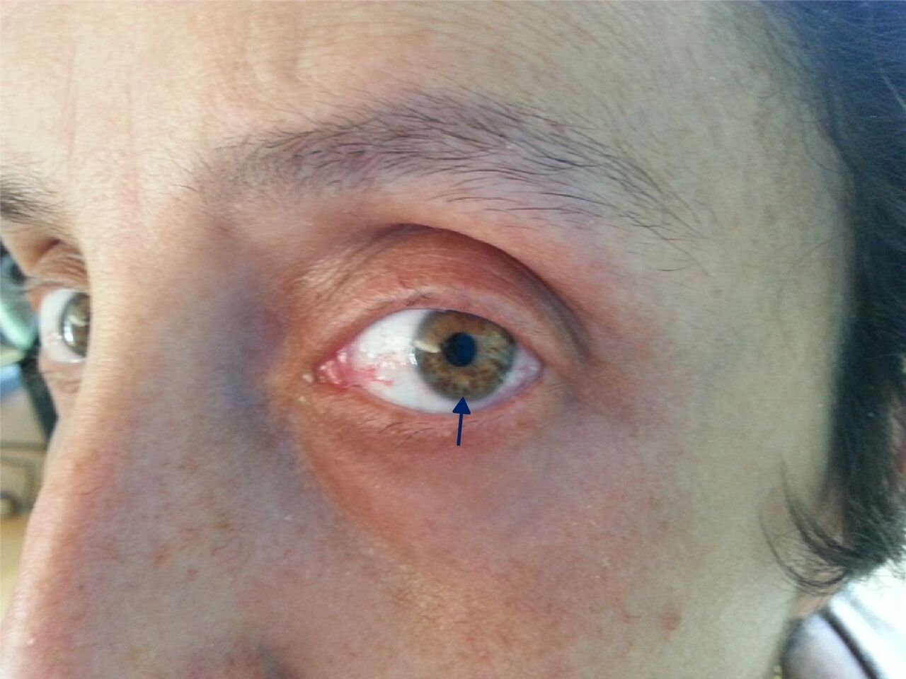 La neurofibromatosis Tipo 1 (NF1), una enfermedad genética “rara”, crónica, grave, discapacitante y progresiva.