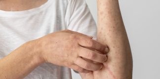Mayo Clinic desarrolla una herramienta para acelerar los diagnósticos de las pruebas de alergia cutánea