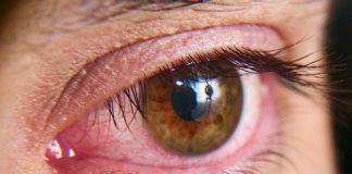 El ojo seco es una molestia cotidiana que puede convertirse en una condición crónica