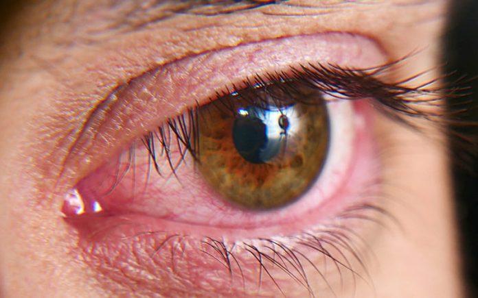 El ojo seco es una molestia cotidiana que puede convertirse en una condición crónica